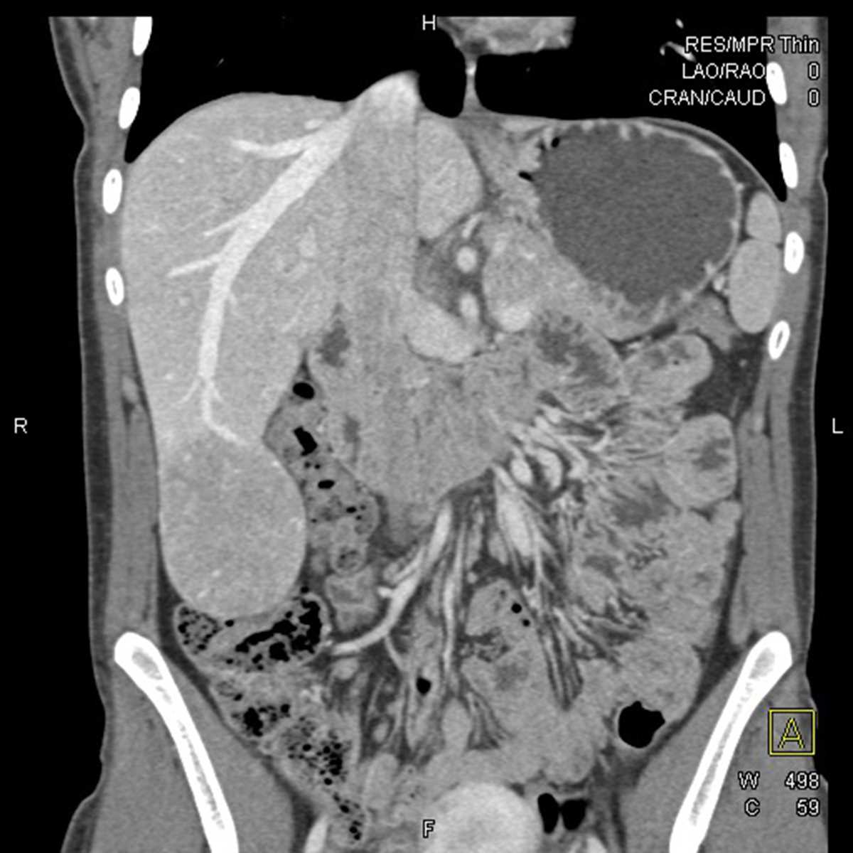 Hepatic Adenoma - Body MR Case Studies - CTisus CT Scanning