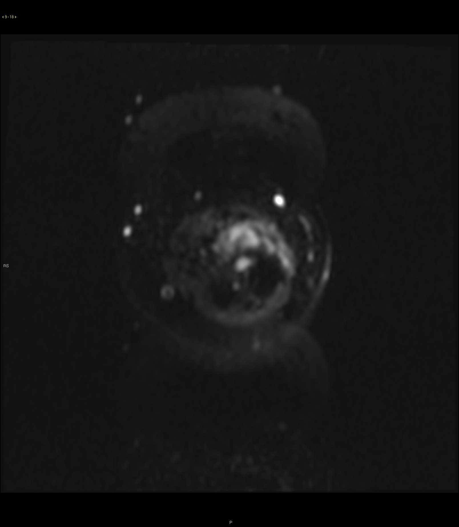 Desmoid - CTisus CT Scan