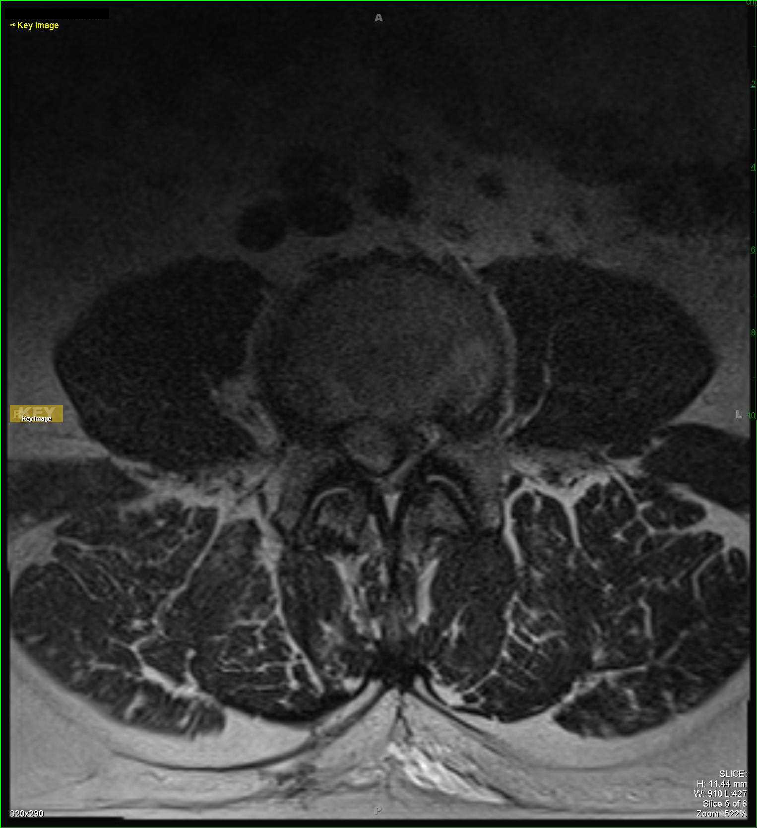 Extruded Disc - CTisus CT Scan