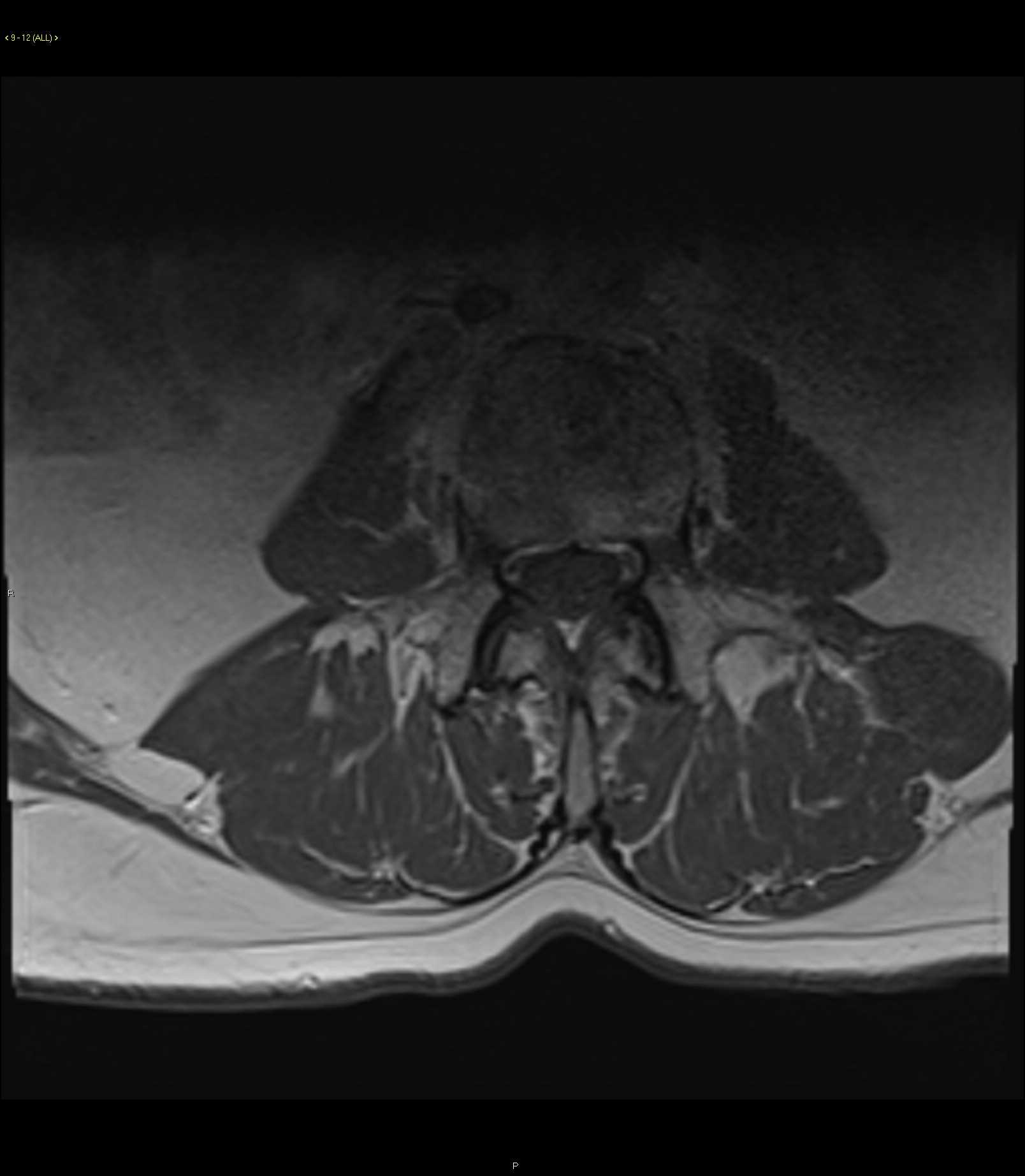 Metastatic Pancreatic Adenocarcinoma - CTisus CT Scan