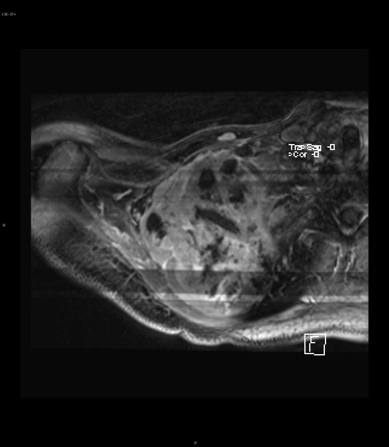 Pleomorphic Sarcoma Right Shoulder - CTisus CT Scan