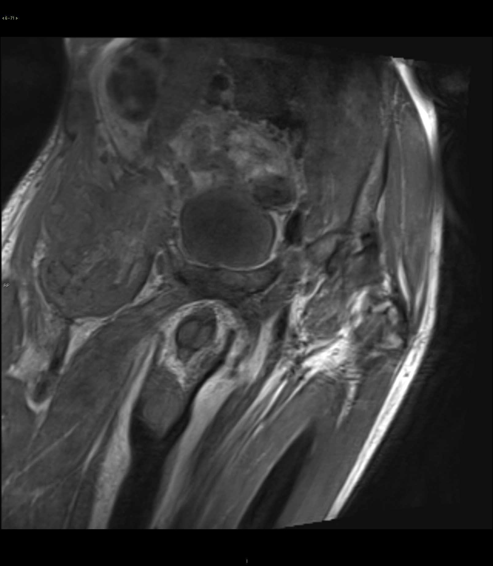 High Grade Sarcoma Right Inguinal Region - CTisus CT Scan