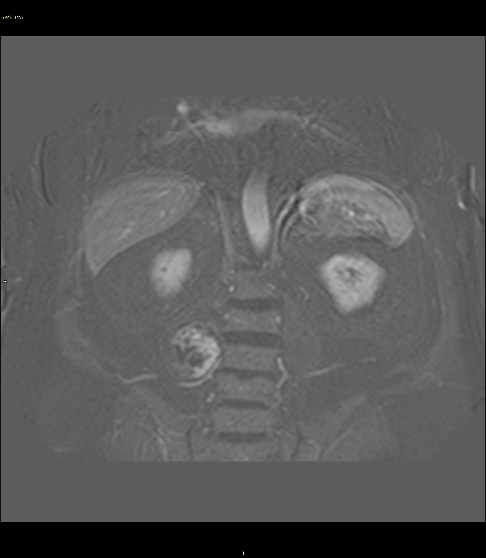 Schwannoma - CTisus CT Scan