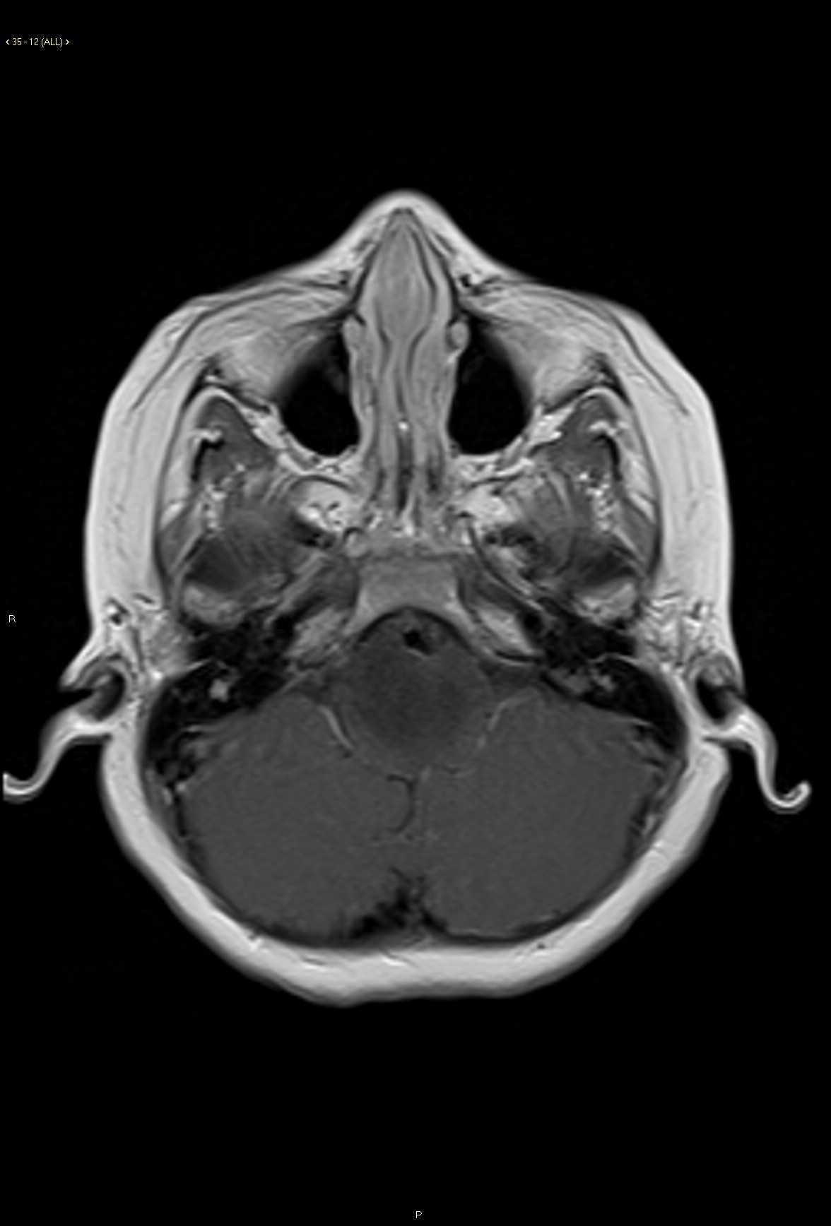 Brainstem Glioma Low-grade - CTisus CT Scan