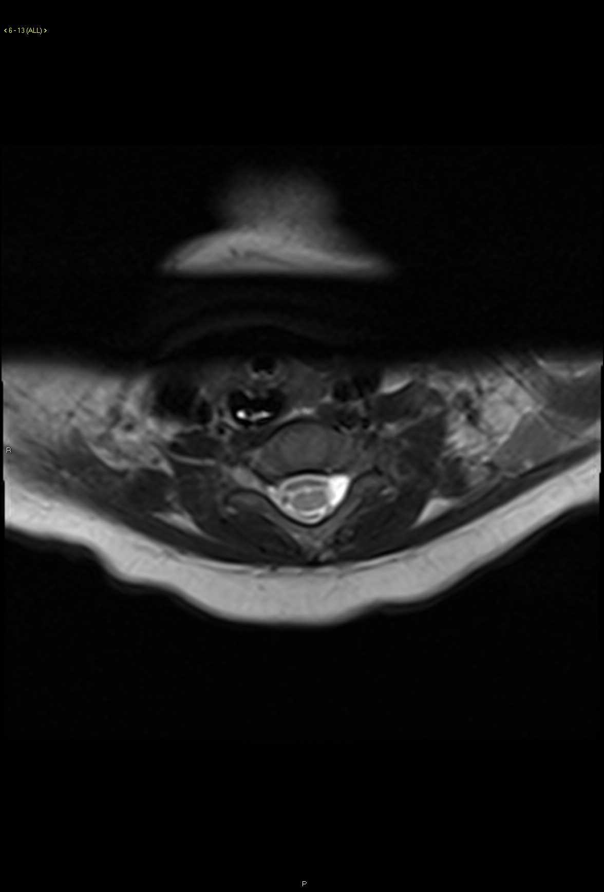 Traumatic Meningocele - CTisus CT Scan