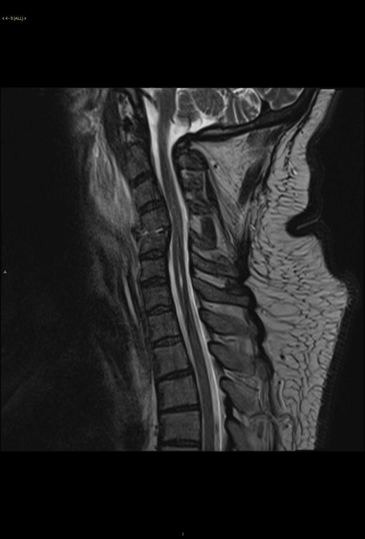 Discitis Osteomyelitis - CTisus CT Scan