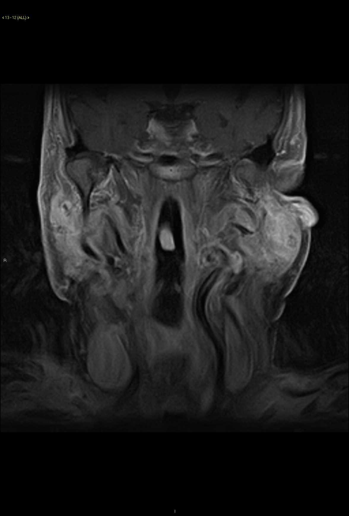 Carcinoma ex pleomorphic adenoma - CTisus CT Scan