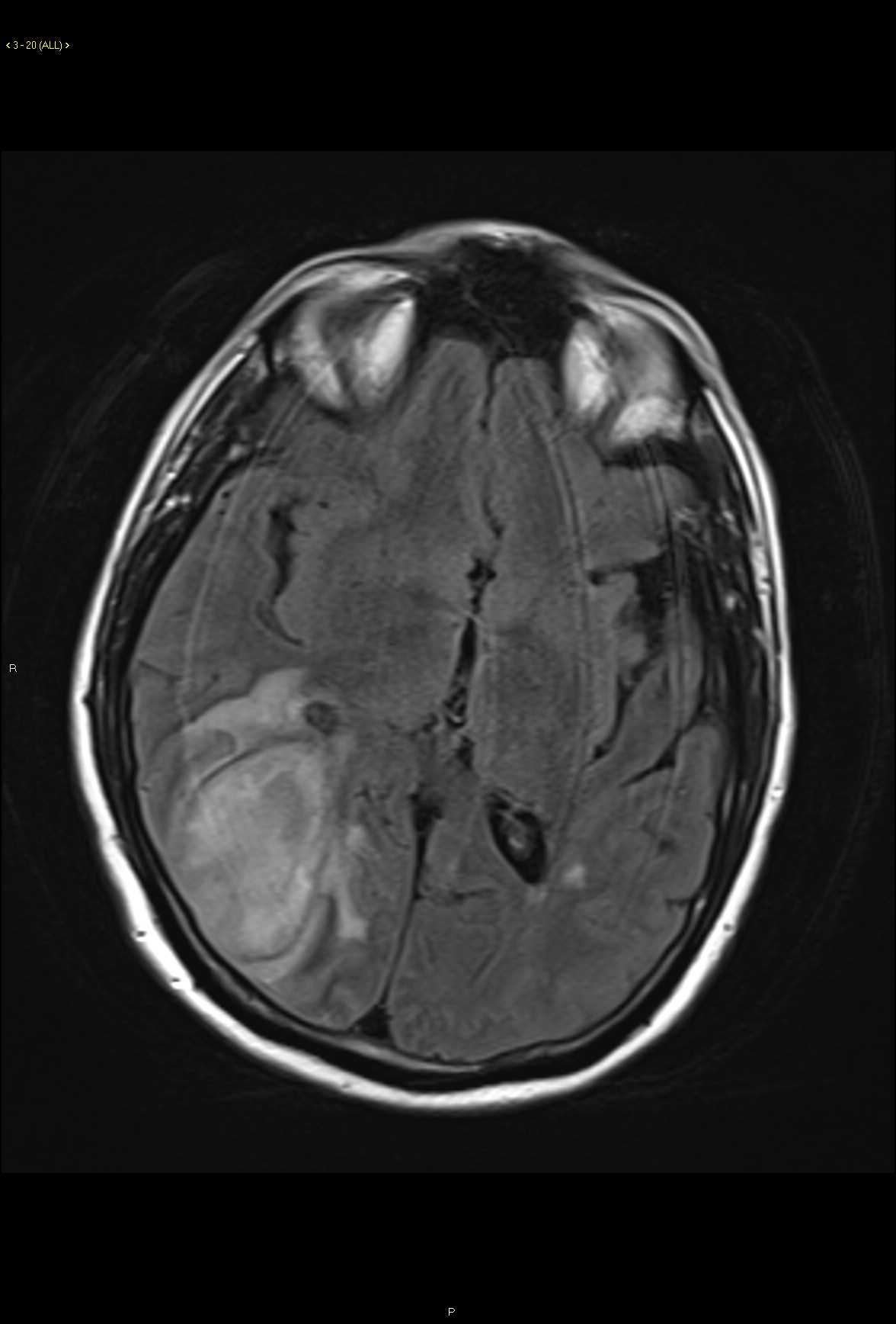 Intracranial Abscess - CTisus CT Scan