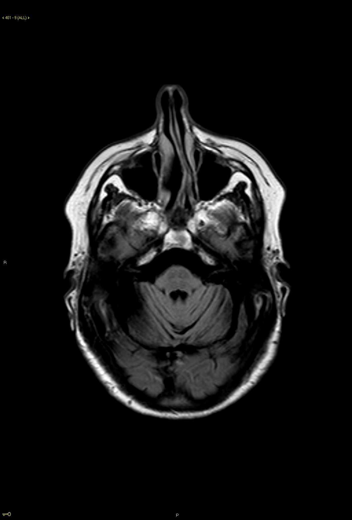 Multisystem Atrophy - CTisus CT Scan