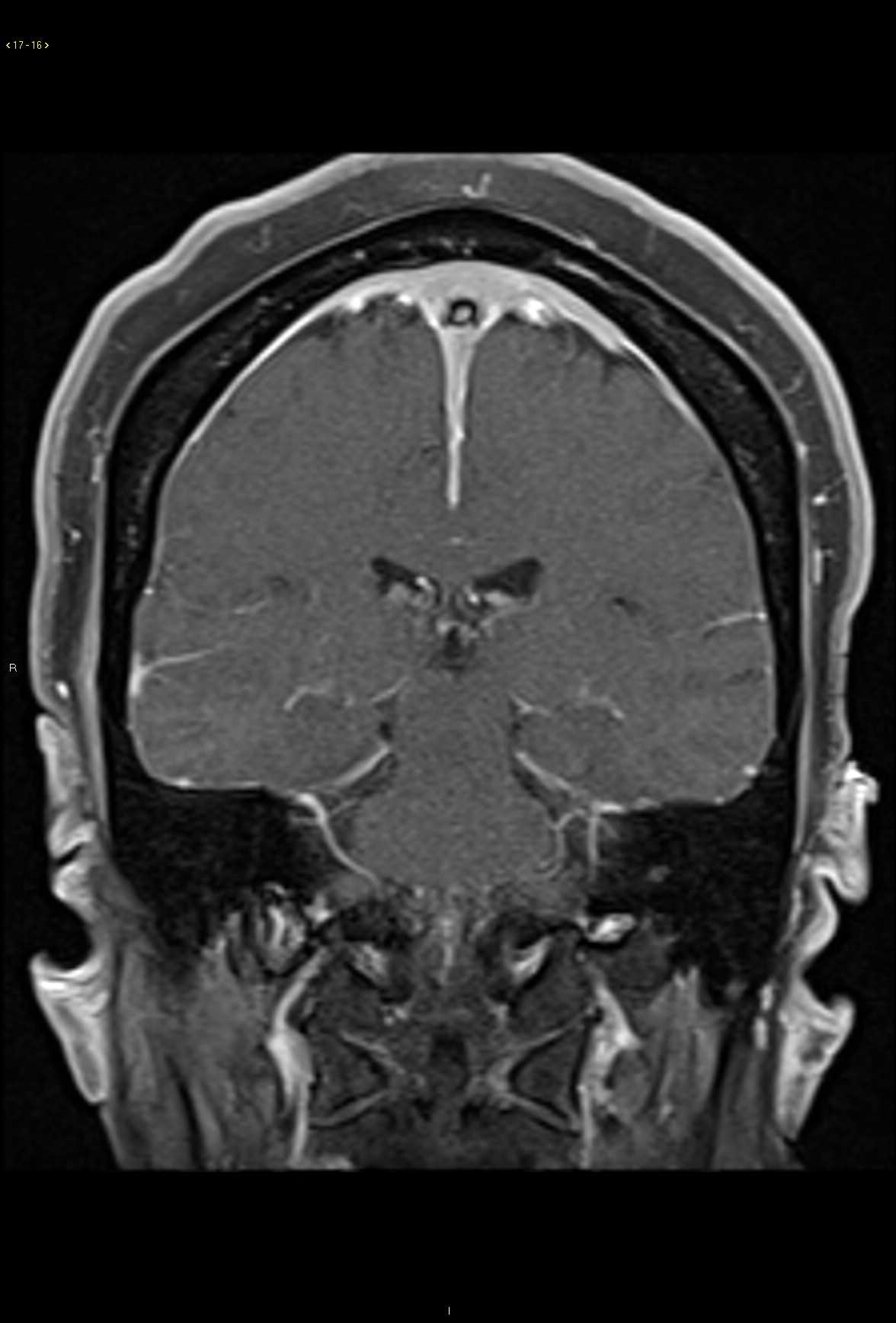 Rosai Dorfman - CTisus CT Scan