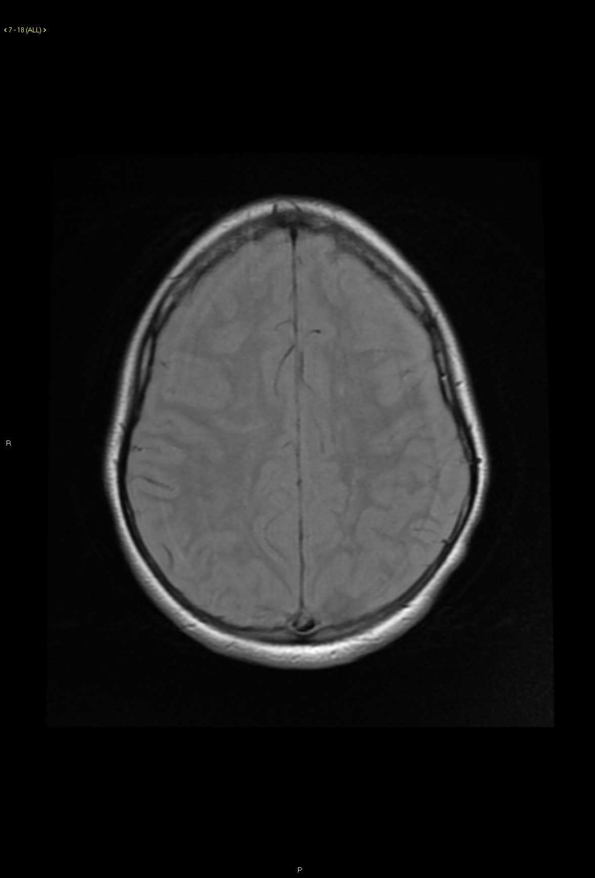 Susac Disease - CTisus CT Scan