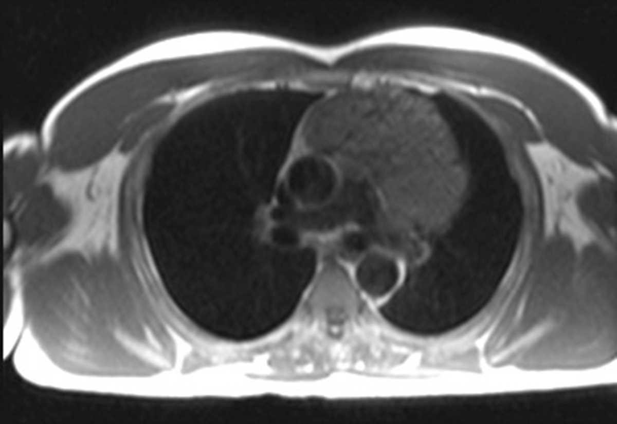 Thymoma - CTisus CT Scan