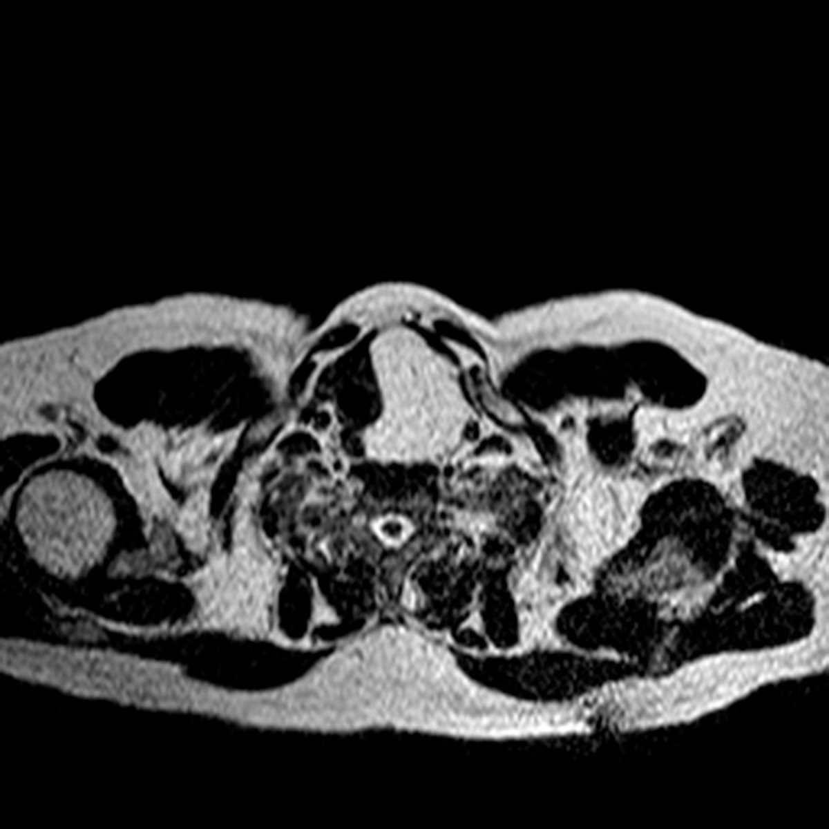 Neck Lipoma - CTisus CT Scan