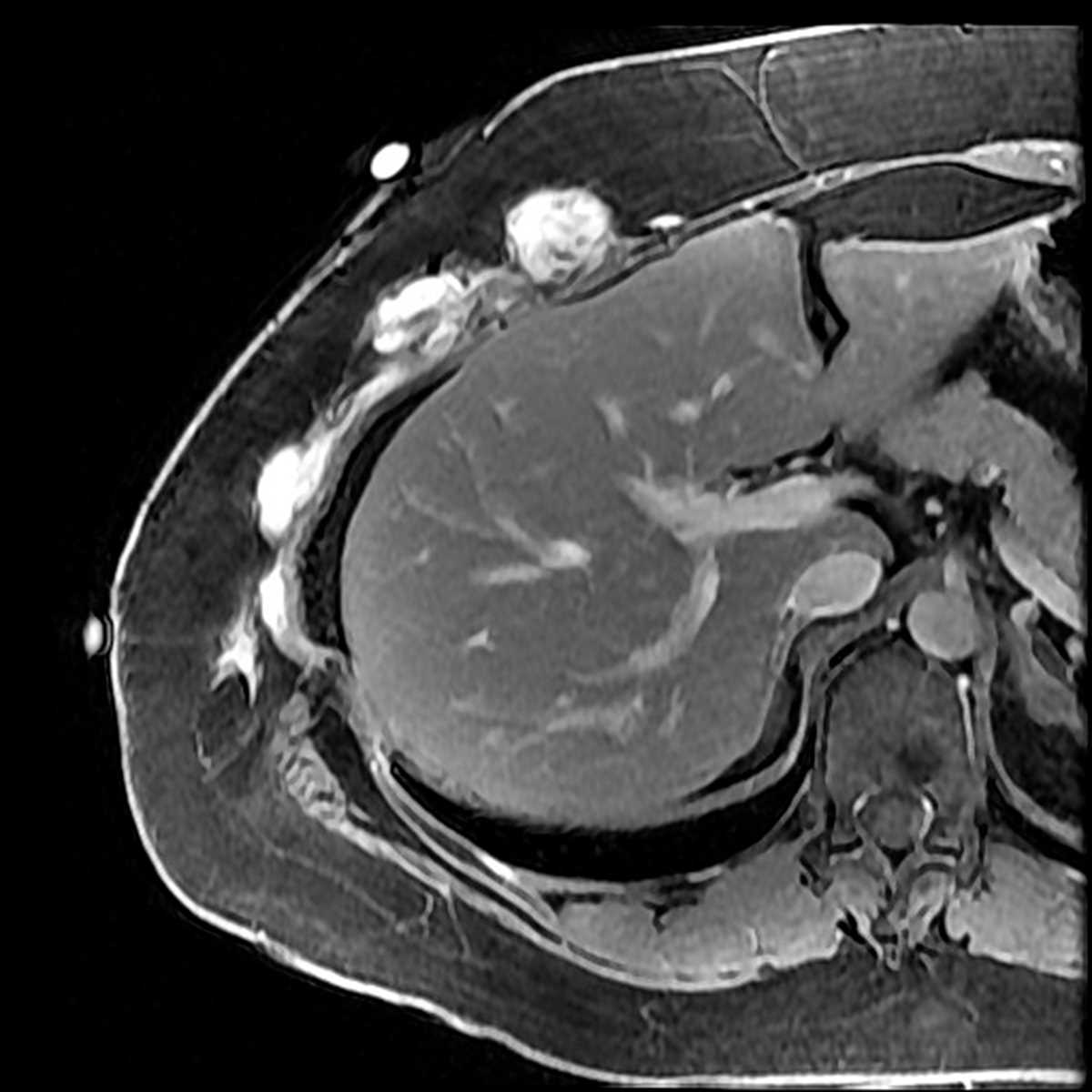 Desmoid - CTisus CT Scan