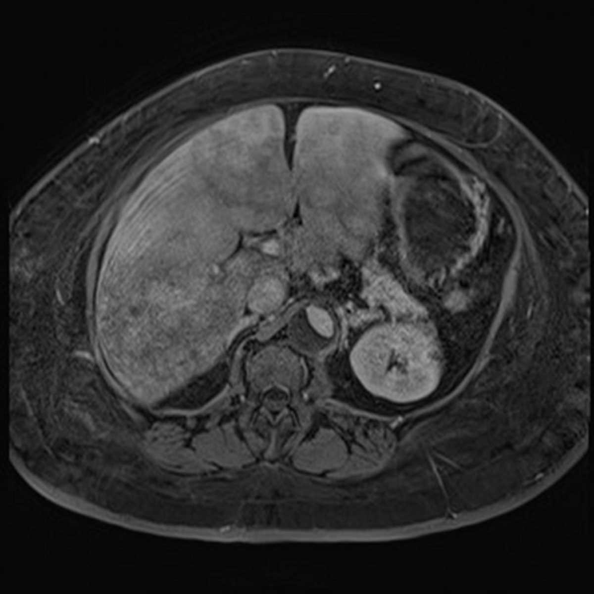 Passive hepatic congestion - CTisus CT Scan