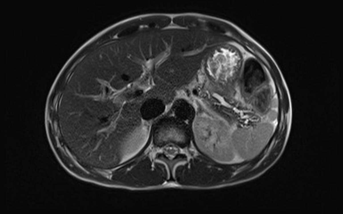 Chronic Pancreatitis - CTisus CT Scan