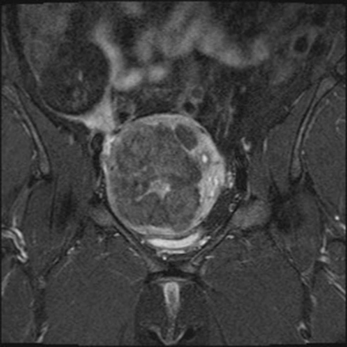 Ovarian dermoid - Body MR Case Studies - CTisus CT Scanning