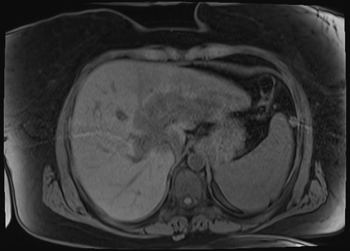 Cholangiocarcinoma - CTisus CT Scan