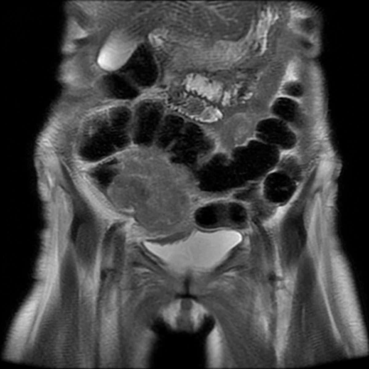 Colon cancer - CTisus CT Scan