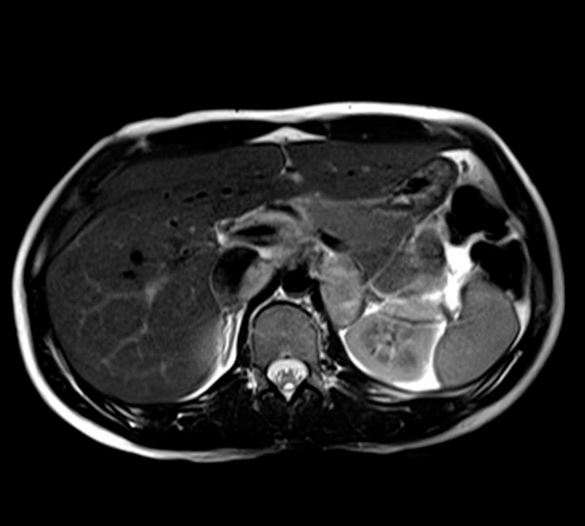 Plexiform neurofibroma - CTisus CT Scan