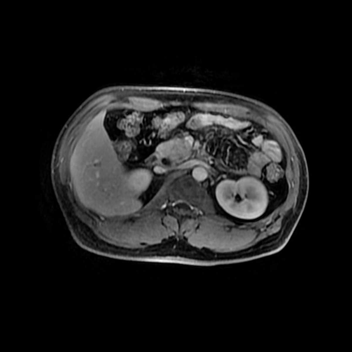 Pancreatic neuroendocrine tumor - CTisus CT Scan