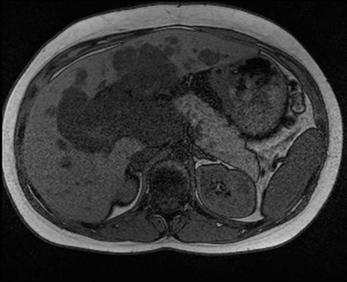 Plexiform neurofibroma - CTisus CT Scan