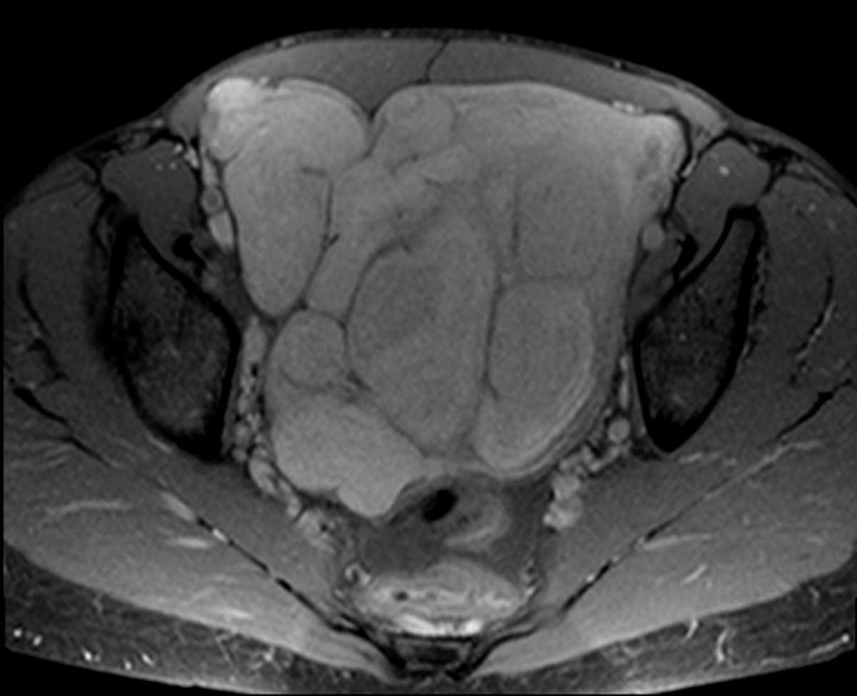 Benign metastasizing leiomyoma - CTisus CT Scan