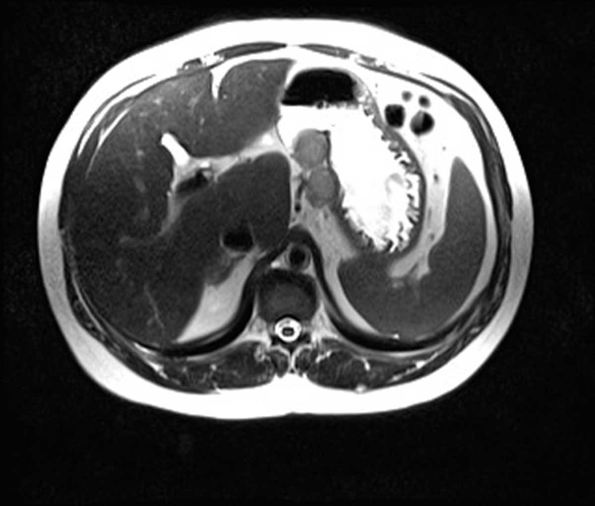 Gastric carcinoid - CTisus CT Scan