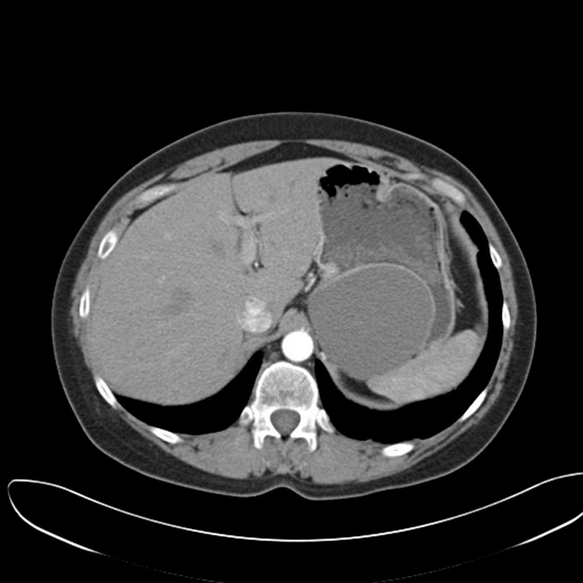 Gastric duplication cyst - CTisus CT Scan