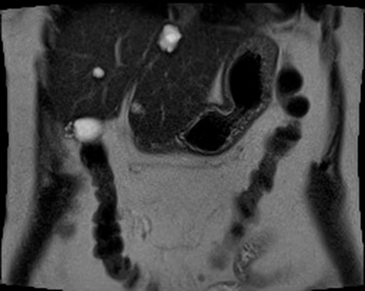 Adenomyomatosis - CTisus CT Scan