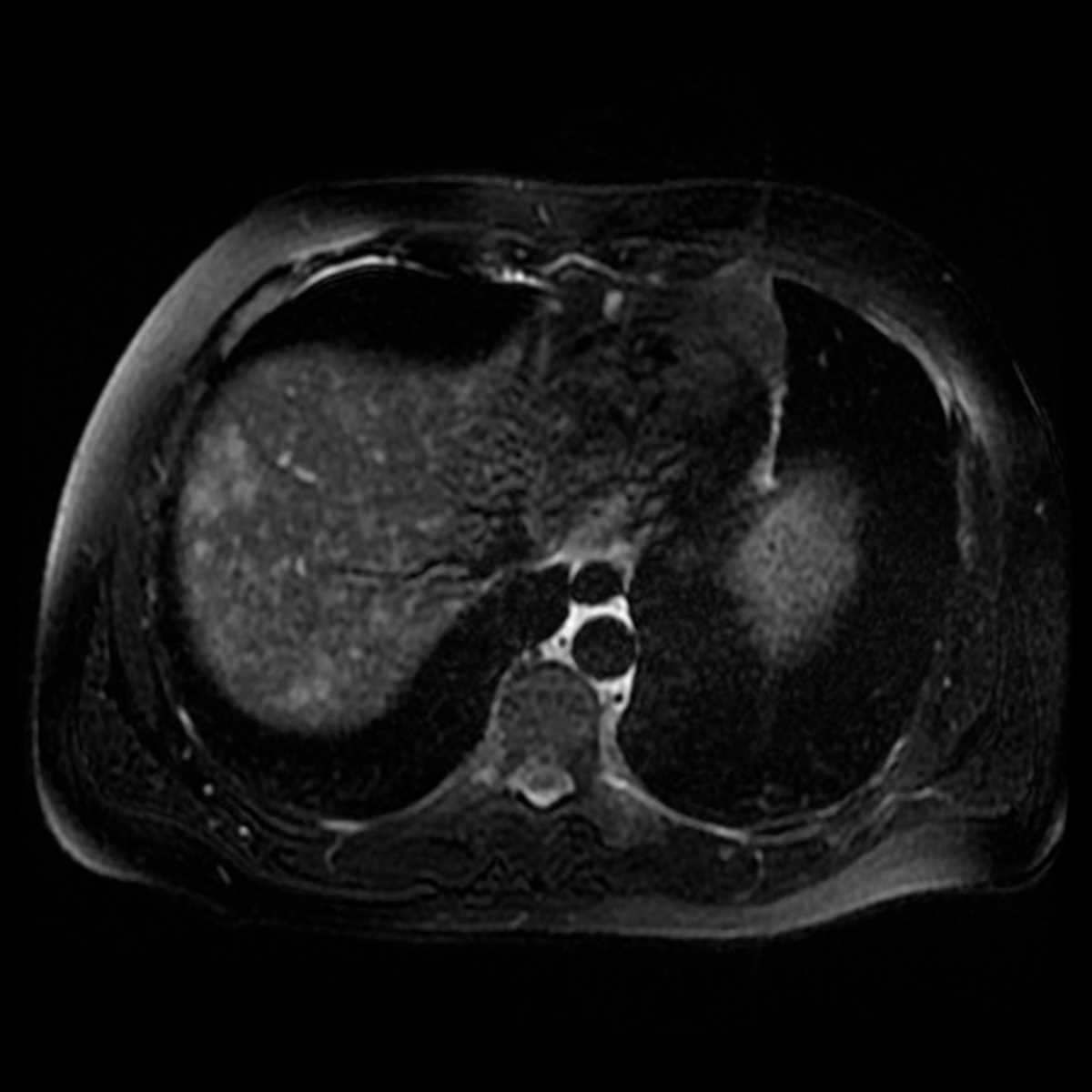 LCH Liver - CTisus CT Scan