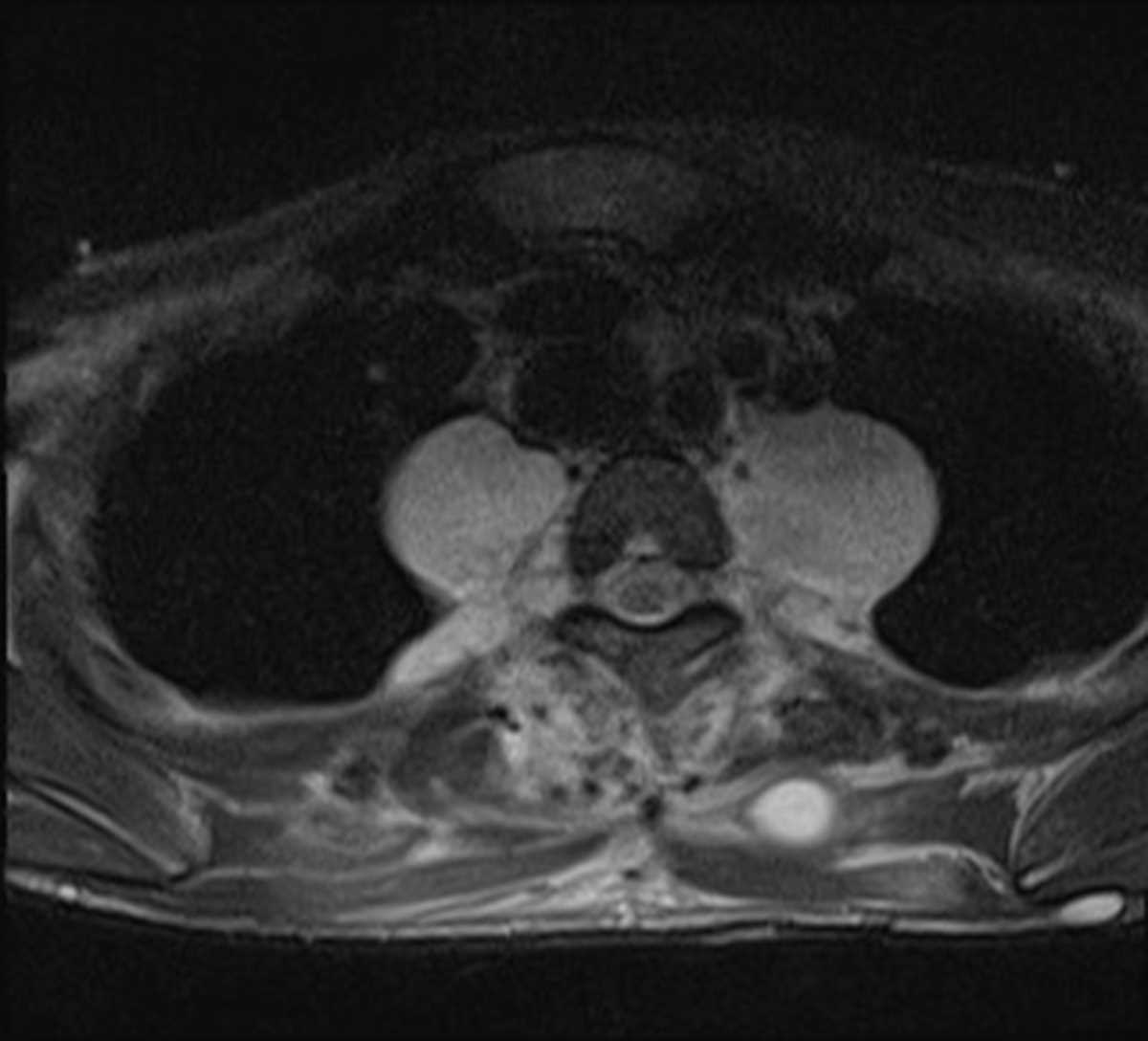 Neurofibromatosis - CTisus CT Scan