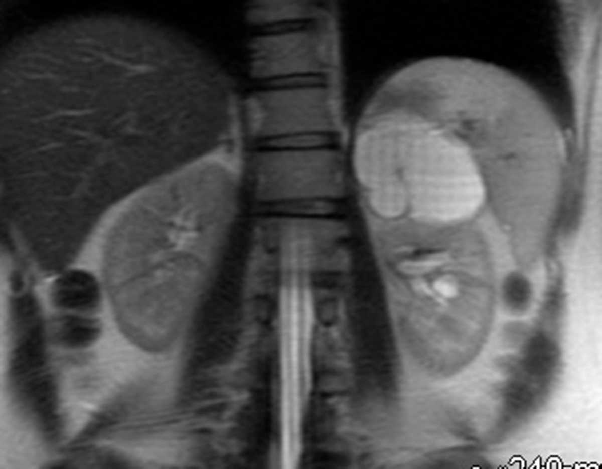 Adrenal cyst - CTisus CT Scan