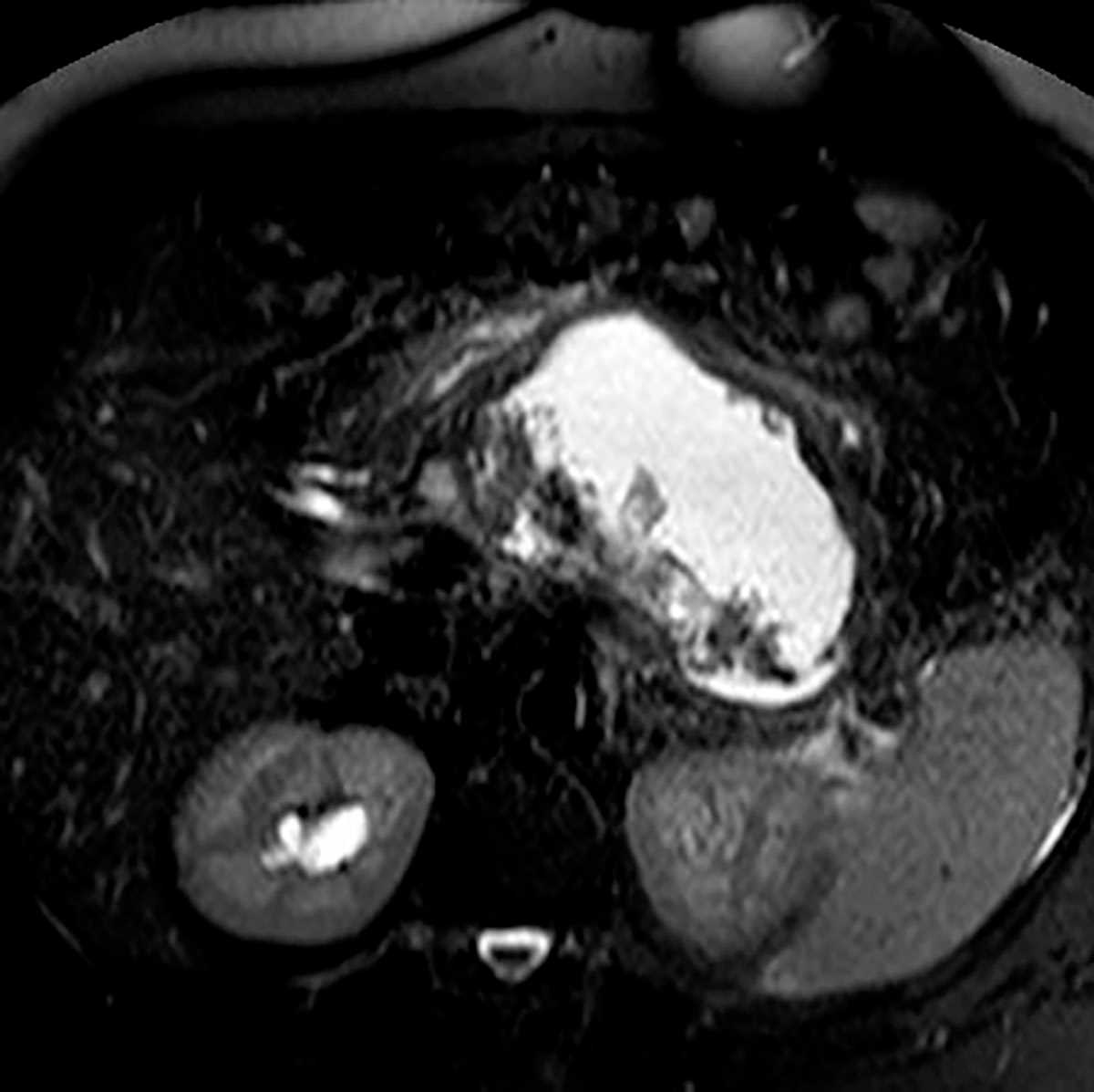 Walled-off necrosis - CTisus CT Scan