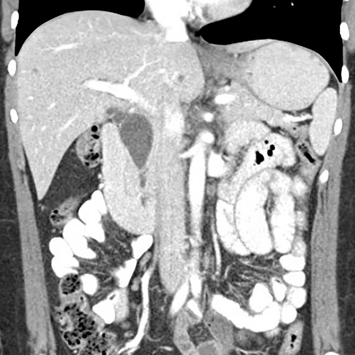 Choledochal cyst with anomalous pancreaticobiliary junction - CTisus CT Scan