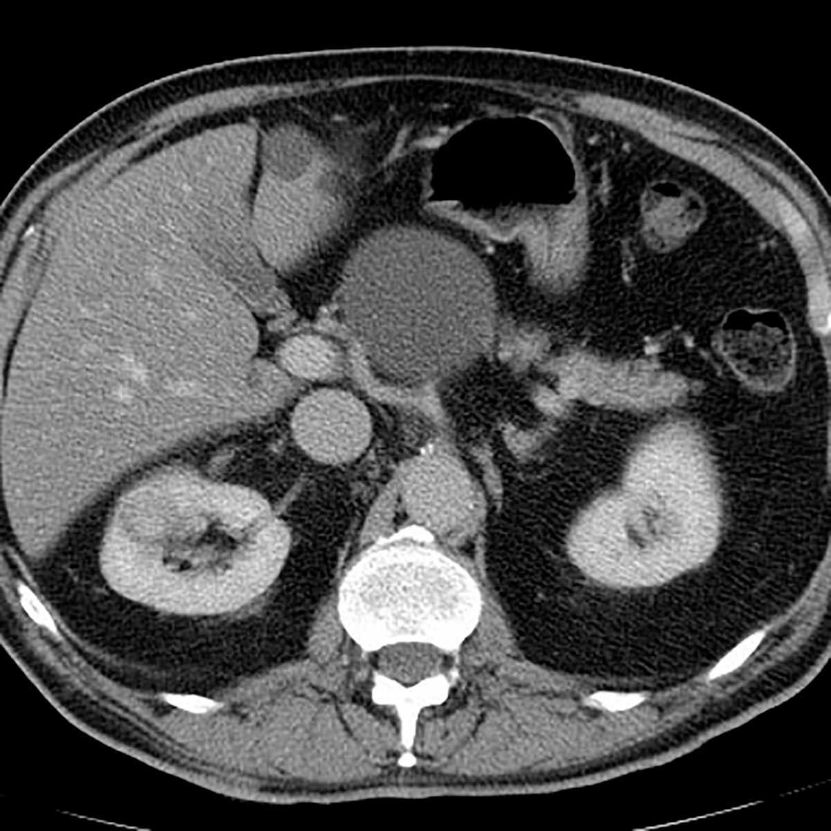 Renal Arteriovenous Malformation (AVM) - CTisus CT Scan