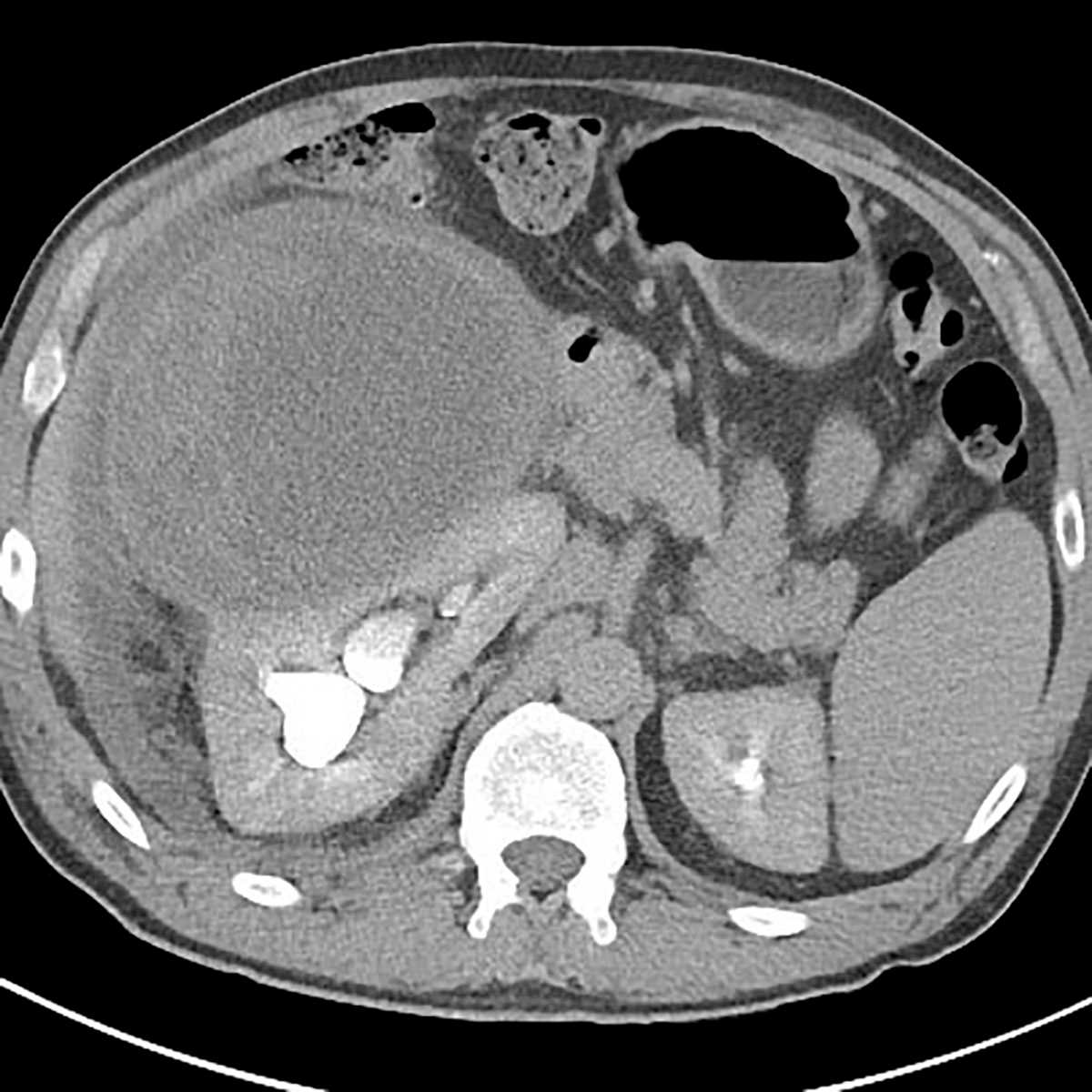 Papillary renal cell carcinoma - CTisus CT Scan