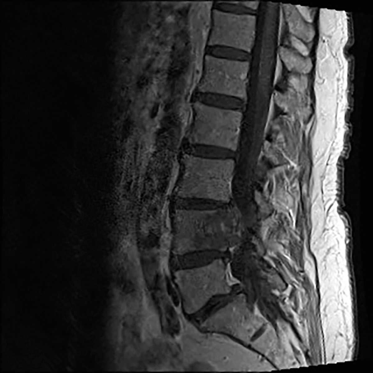 Chordoma - CTisus CT Scan