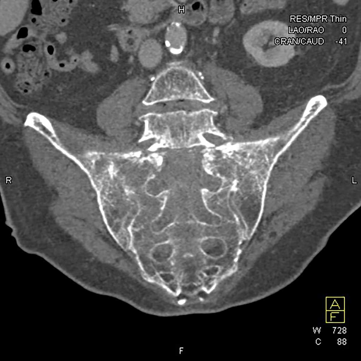 Lymphoma of sacrum - CTisus CT Scan