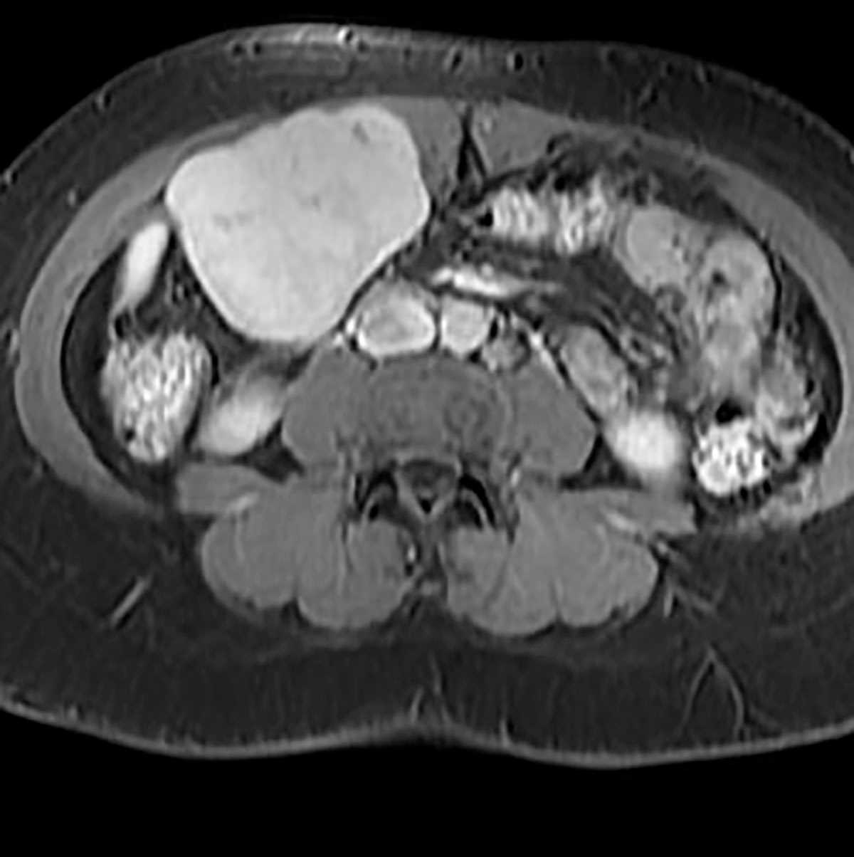 Benign metastasizing leiomyoma - CTisus CT Scan