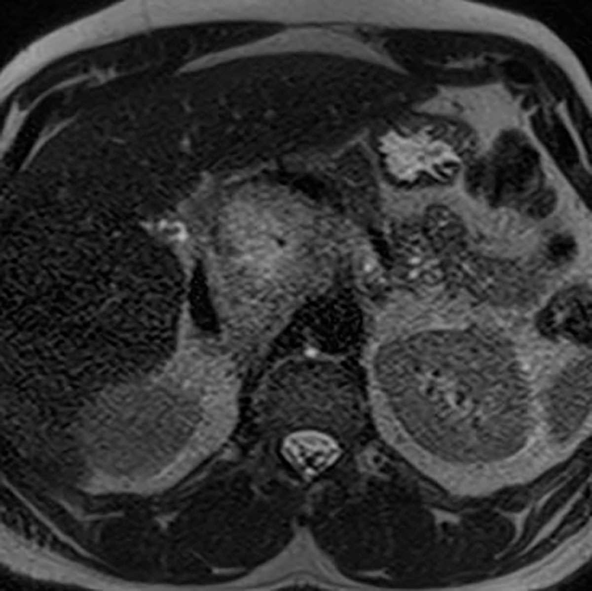 Retroperitoneal paraganglioma - CTisus CT Scan