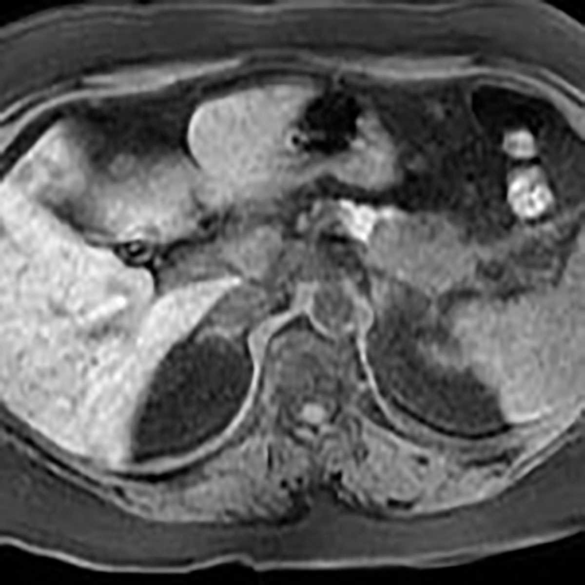 Pancreatic adenocarcinoma - CTisus CT Scan