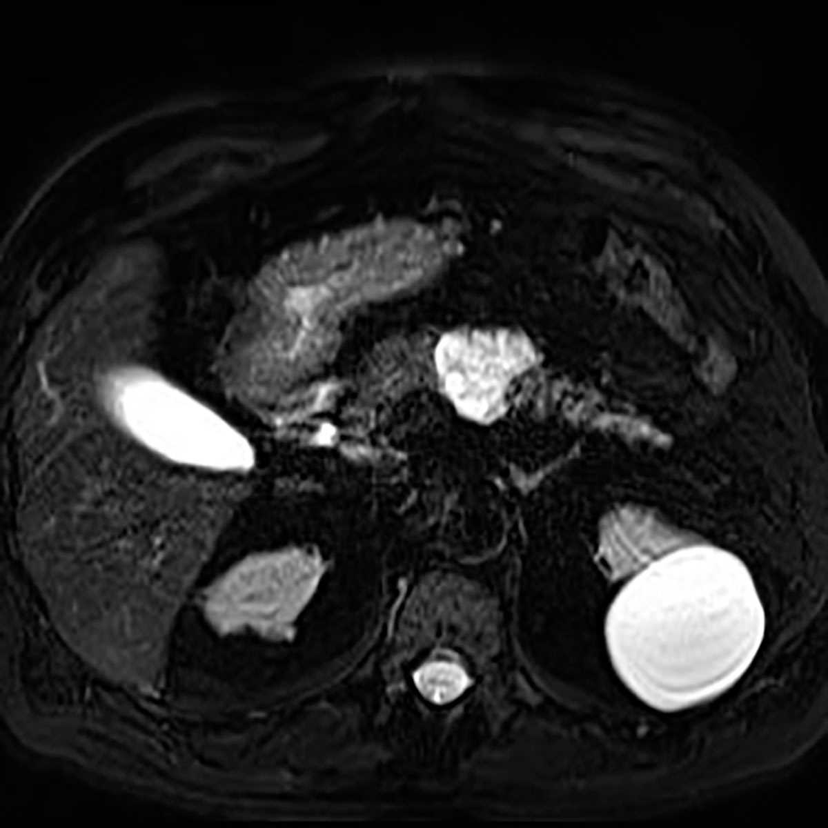 Serous cystadenoma - Body MR Case Studies - CTisus CT Scanning