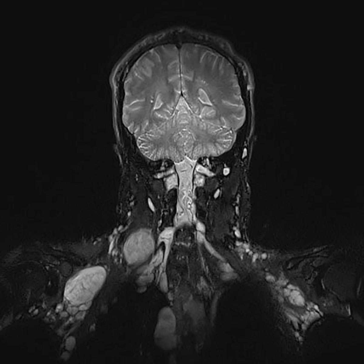 Neurofibromatosis - CTisus CT Scan