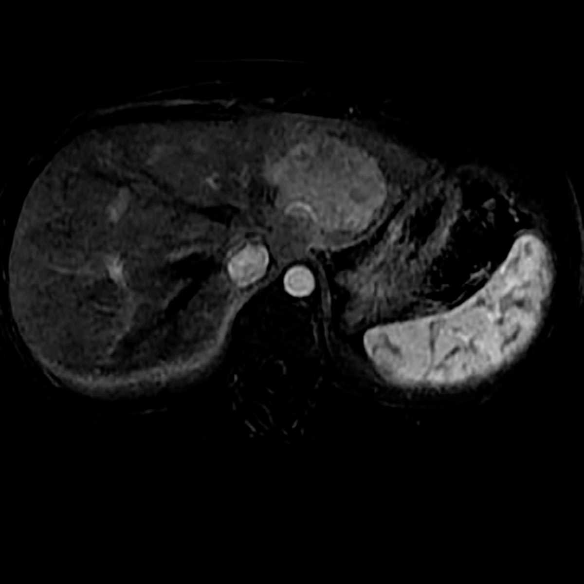 Focal nodular hyperplasia - CTisus CT Scan