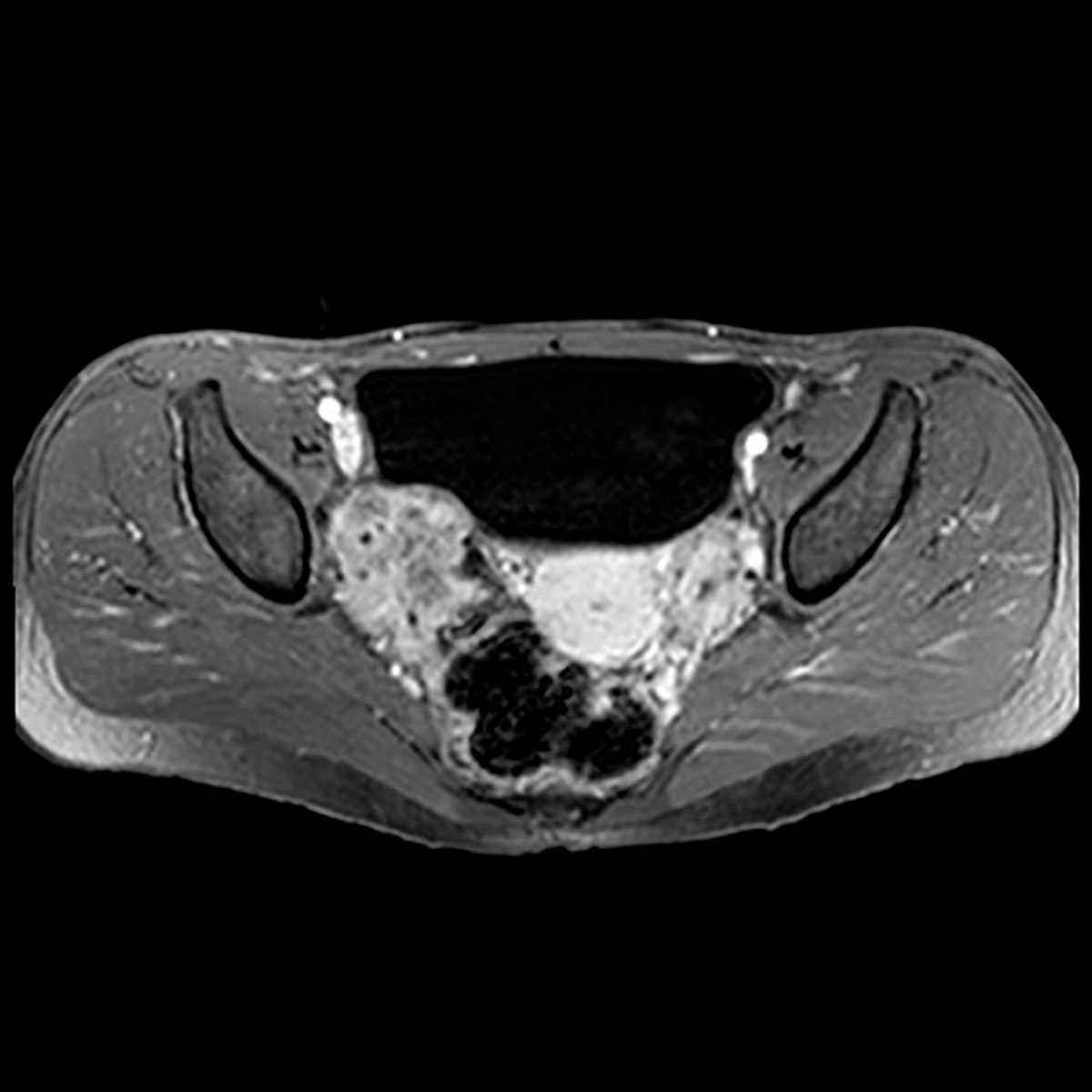Krukenberg tumors of ovaries - CTisus CT Scan