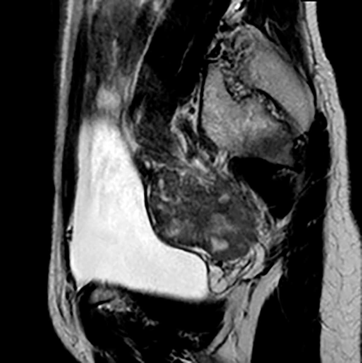Krukenberg tumors of ovaries - CTisus CT Scan