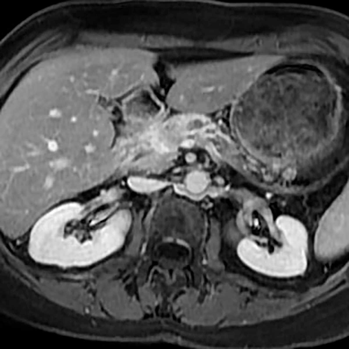 Pancreatic adenocarcinoma - CTisus CT Scan