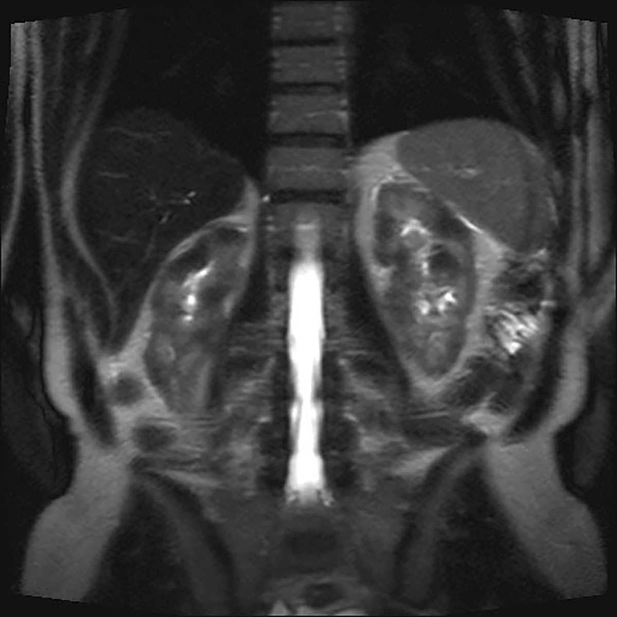 Autoimmune pancreatitis - CTisus CT Scan