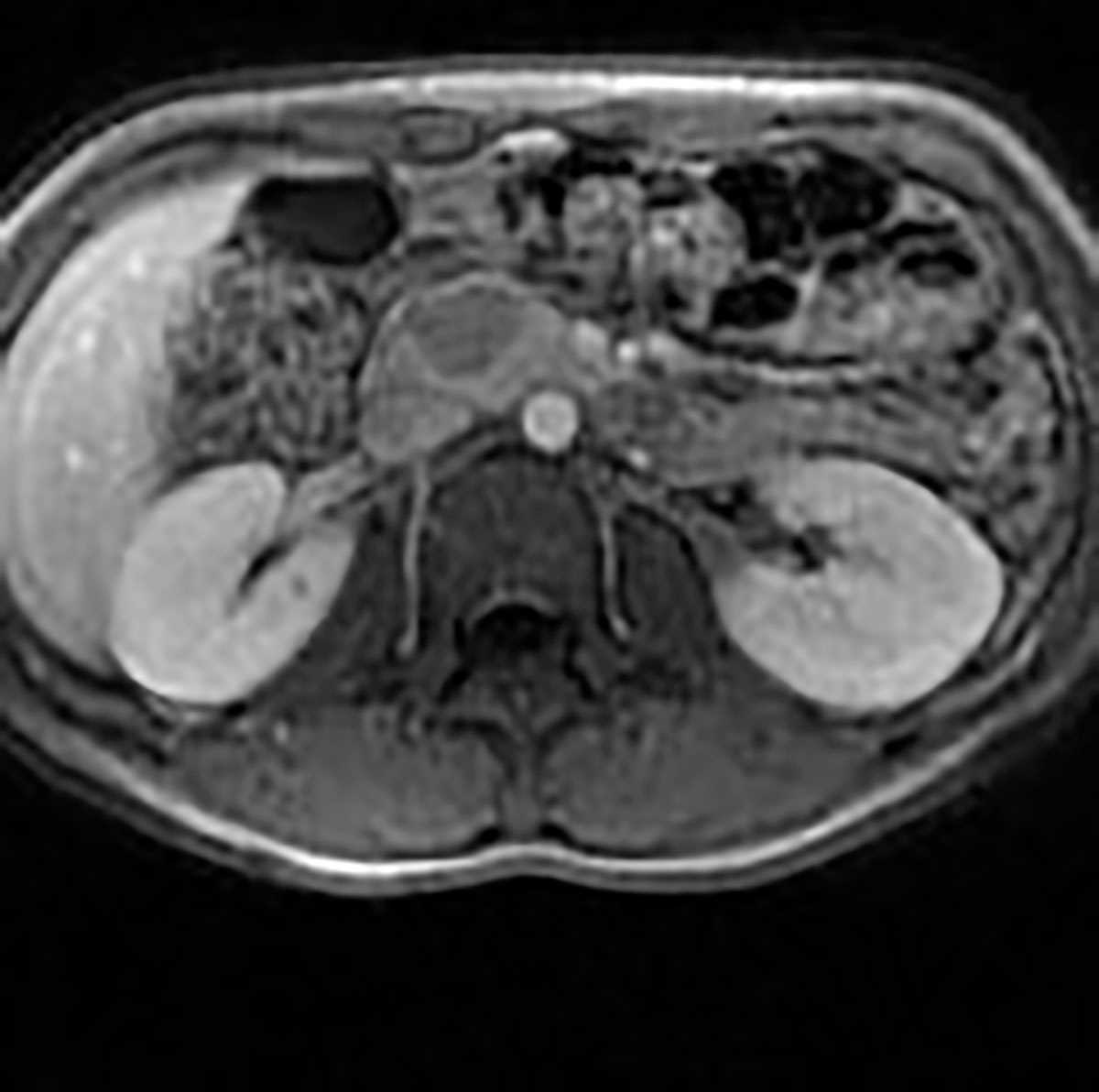 Solid pseudopapillary tumor - CTisus CT Scan
